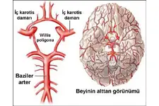 Beyinde Kılcal Damar Daralması Belirtileri ve Tedavisi