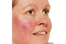 Boğazda Kılcal Damar Çatlaması Belirtileri ve Tedavisi