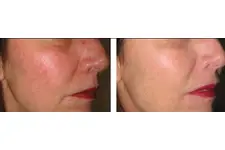 Burunda Kılcal Damar Çatlaması Belirtileri ve Tedavisi