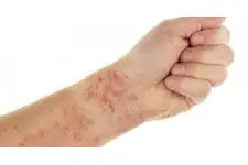 Ciltte Kılcal Damar Çatlaması Belirtileri ve Tedavisi