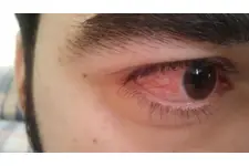 Gözde Kılcal Damar Kanaması Belirtileri ve Tedavisi