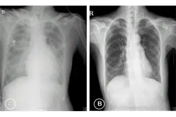 Akciğerde Kılcal Damar Kanaması Belirtileri ve Tedavisi