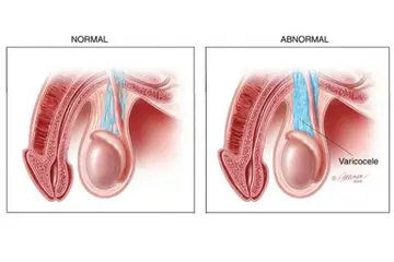 Testiste Kılcal Damar Kanaması Belirtileri ve Tedavisi
